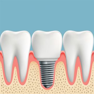 info about dental implants